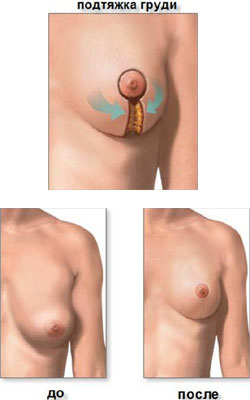 Операция подтяжки груди. Вид груди до операции и после